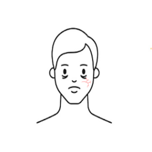 Small Vein Face - 3 Session