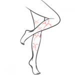 VL-FV - Leg Veins both legs - Package of 5