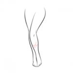 VL-FV - Leg Veins Large Area - Single Session