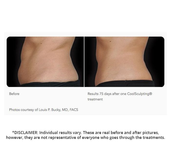 Coolsculpting Toronto How It Works And Best Uses