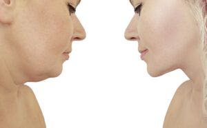Treatments for Double Chin