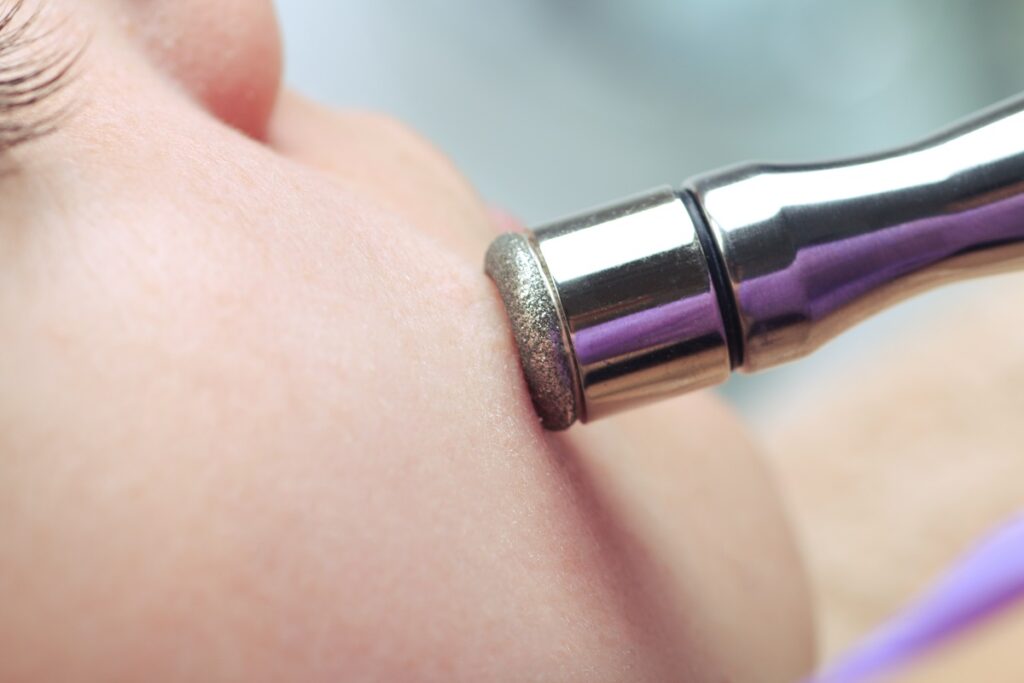 What is Microdermabrasion? 