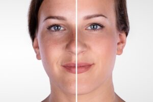 What is Microdermabrasion? 