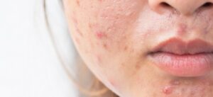 Girl with problematic skin and scars from acne (scar)