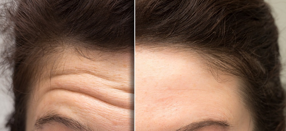 How To Get Rid Of Forehead Wrinkles