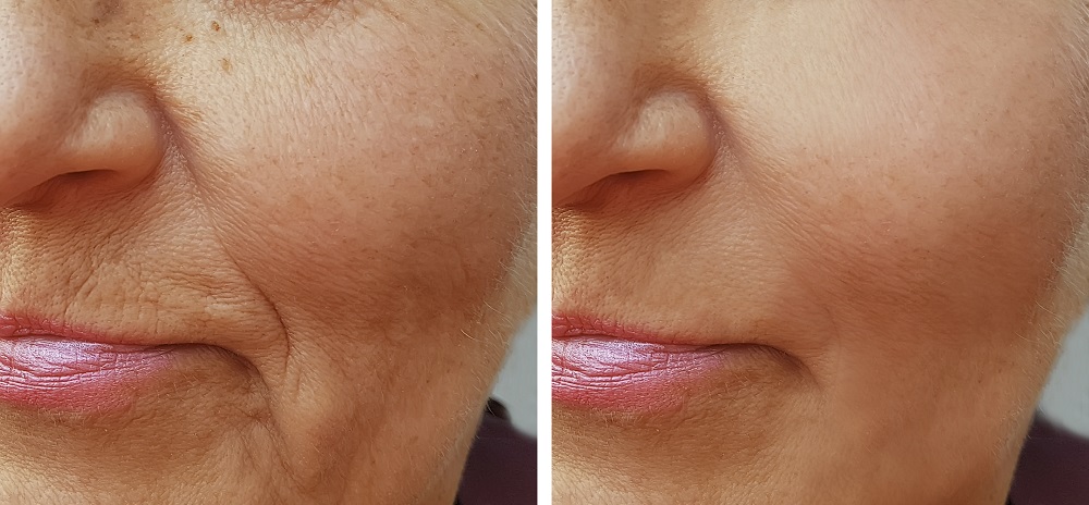 Face Skin Tightening Toronto  Superior Laser Skin Tightening