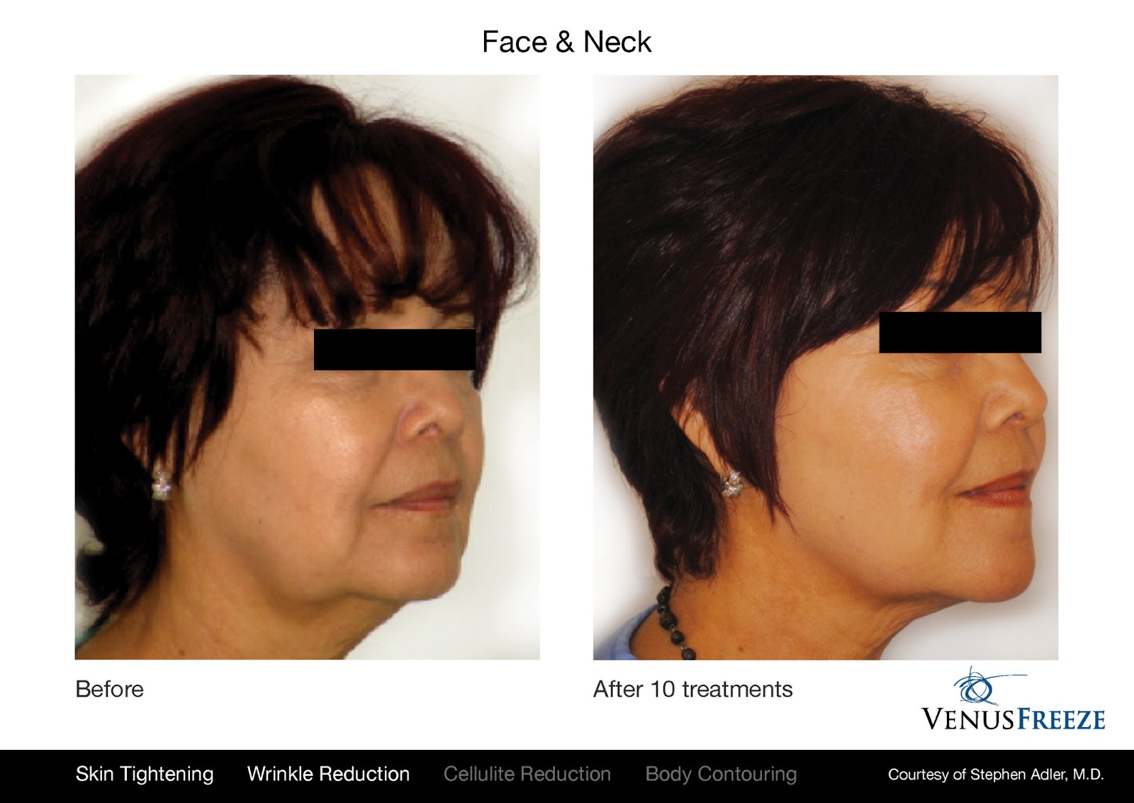 Top 5 Reasons Why You Need Skin Rejuvenation Treatment