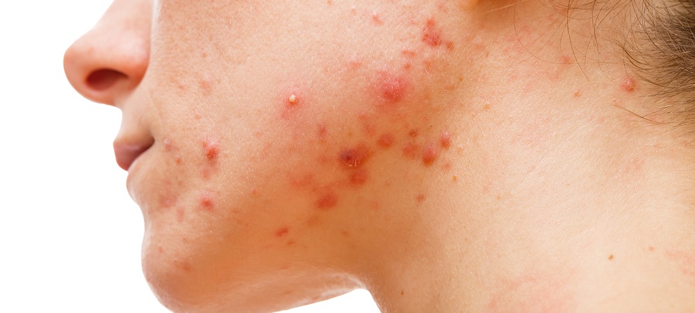 acne rosacea vs acne vulgaris