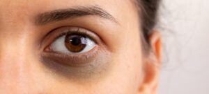 How to Get Rid of Dark Circles and Under Eye Bags