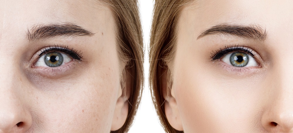 How To Get Rid Of Bags Under Eyes & Dark Circles