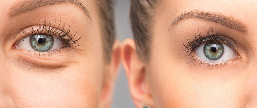 Bags Under Eyes? Here's What You Can Do