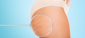 Best Treatments for Removing Cellulite