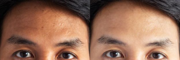 What Are The Causes of Forehead Wrinkles?