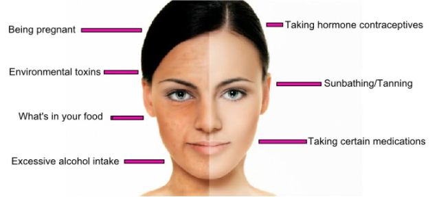 Melasma