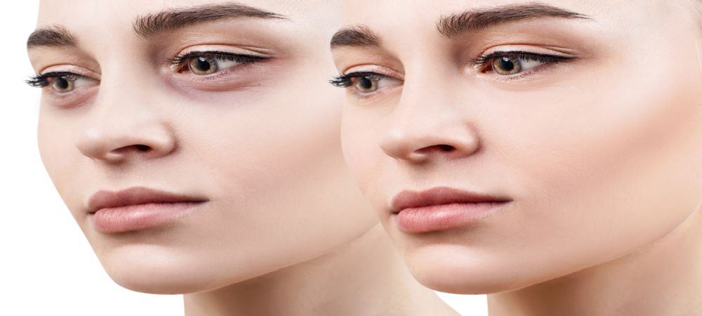 Under Eye Filler Treatments