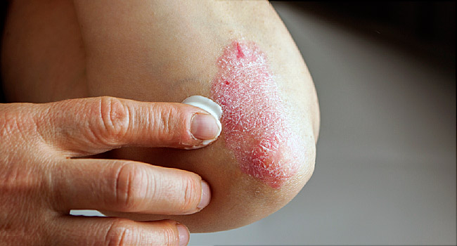dry skin 