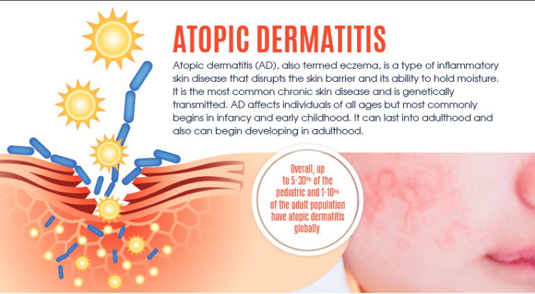 Atopic dermatitis