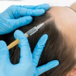 prp hair treatment