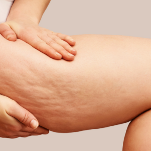 Cellulite on woman's thigh