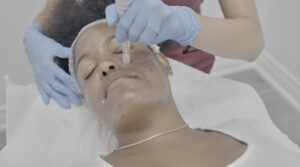 Microneedling image
