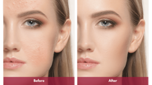 Before and After Microneedling Treatment