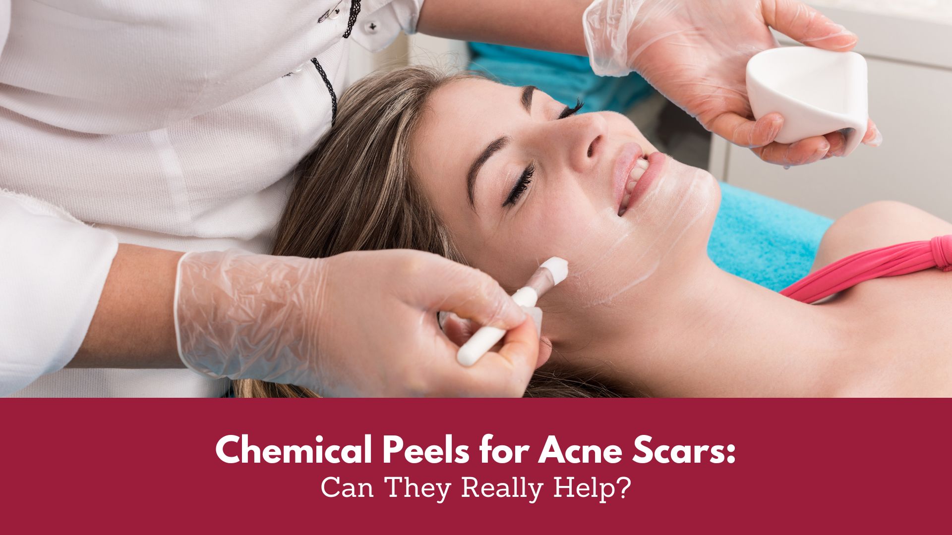 Chemical Peels For Acne Scars Can They Really Help Canada MedLaser