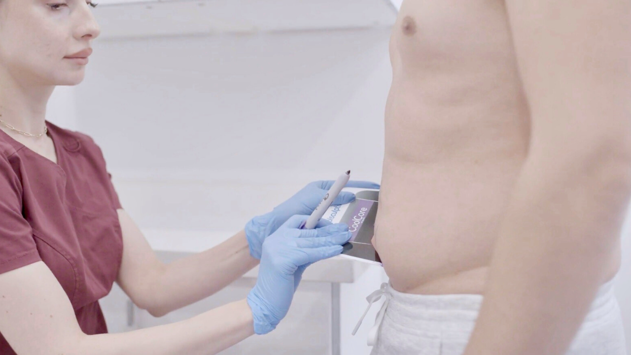 CoolSculpting