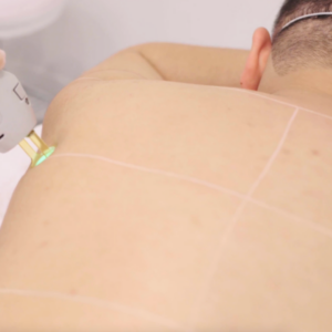 Full body laser hair removal treatment with Canada MedLaser