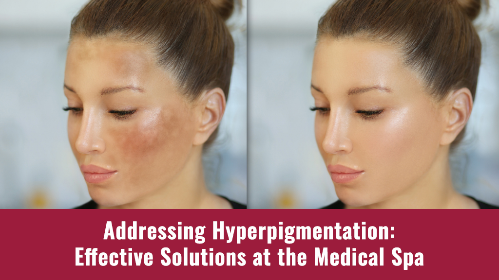 Hyperpigmentation treatment