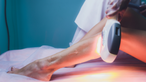 This is a laser hair removal blog image