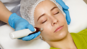 Microneedling treatment blog image