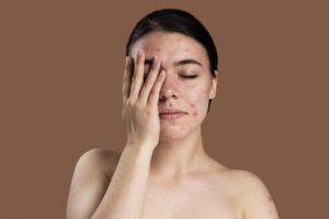 Your Guide to Hormonal Acne Treatments: What You Can Do