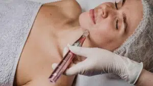 Microneedling with exosomes - woman going through treatment