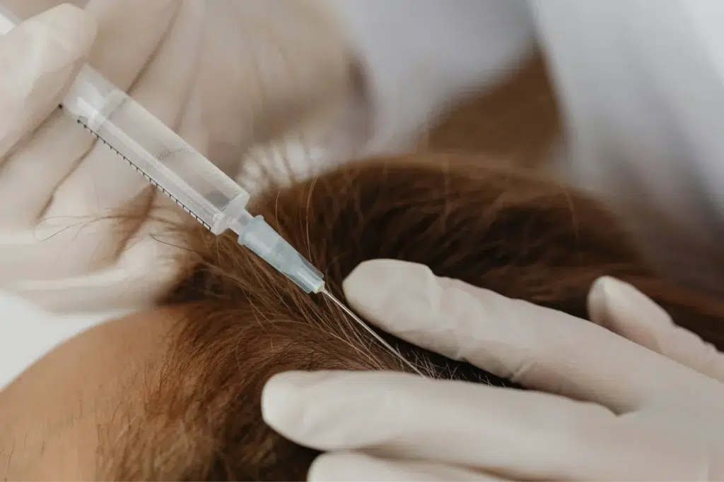 Exosome Hair treatment- needle