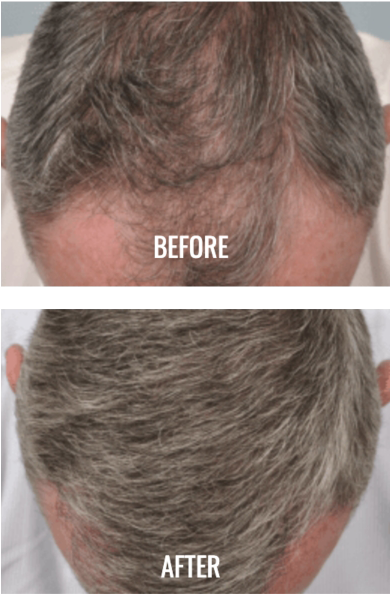 prp-before-and-after-1 - Canada MedLaser