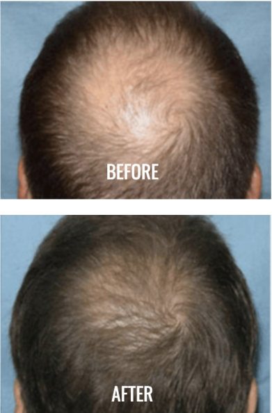 prp-before-and-after-2 - Canada MedLaser