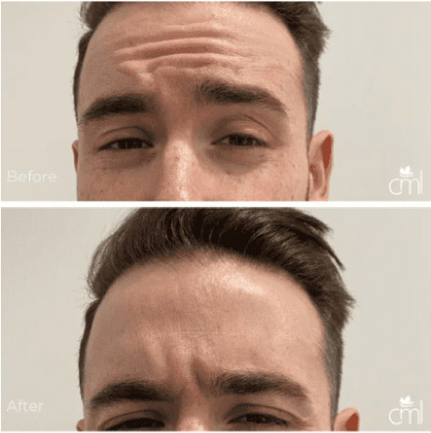 section-cosmetic-injection-before-after-1