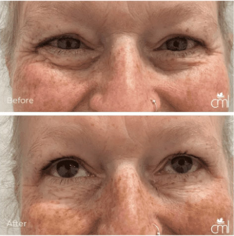 section-cosmetic-injection-before-after-2
