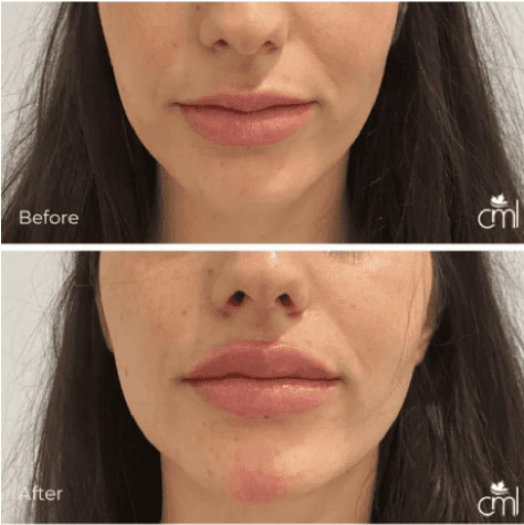 section-cosmetic-injection-before-after-3