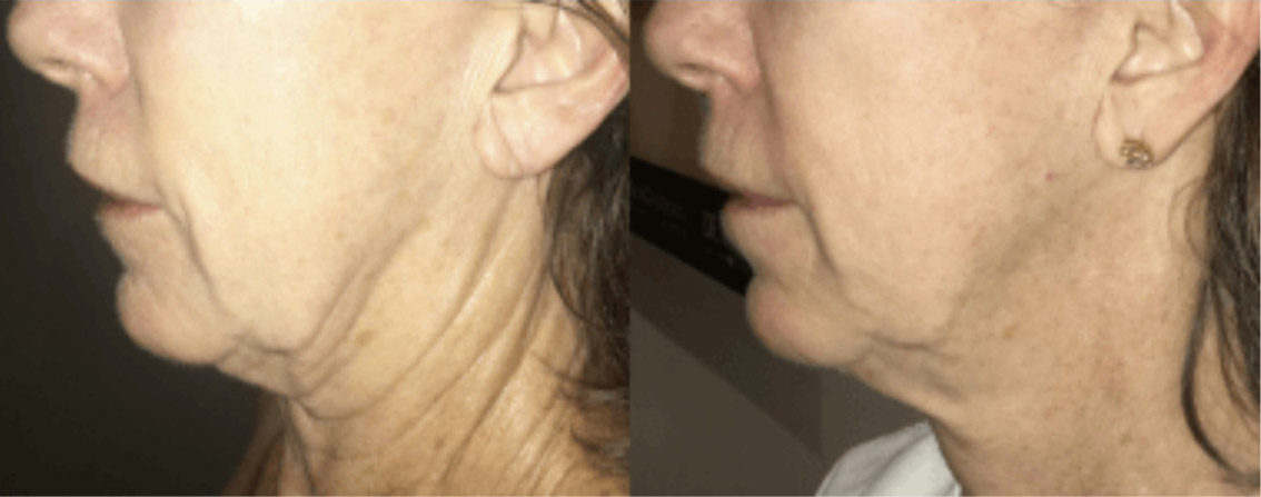 section-morpheus8-before-after-1