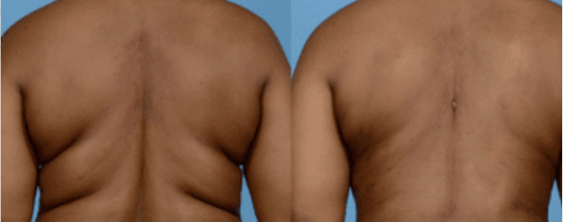 section-morpheus8-before-after-2