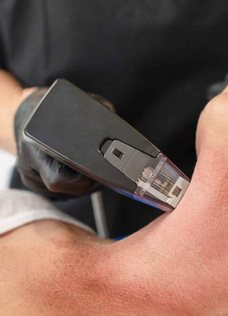 Morpheus8 machine being used on patients neck