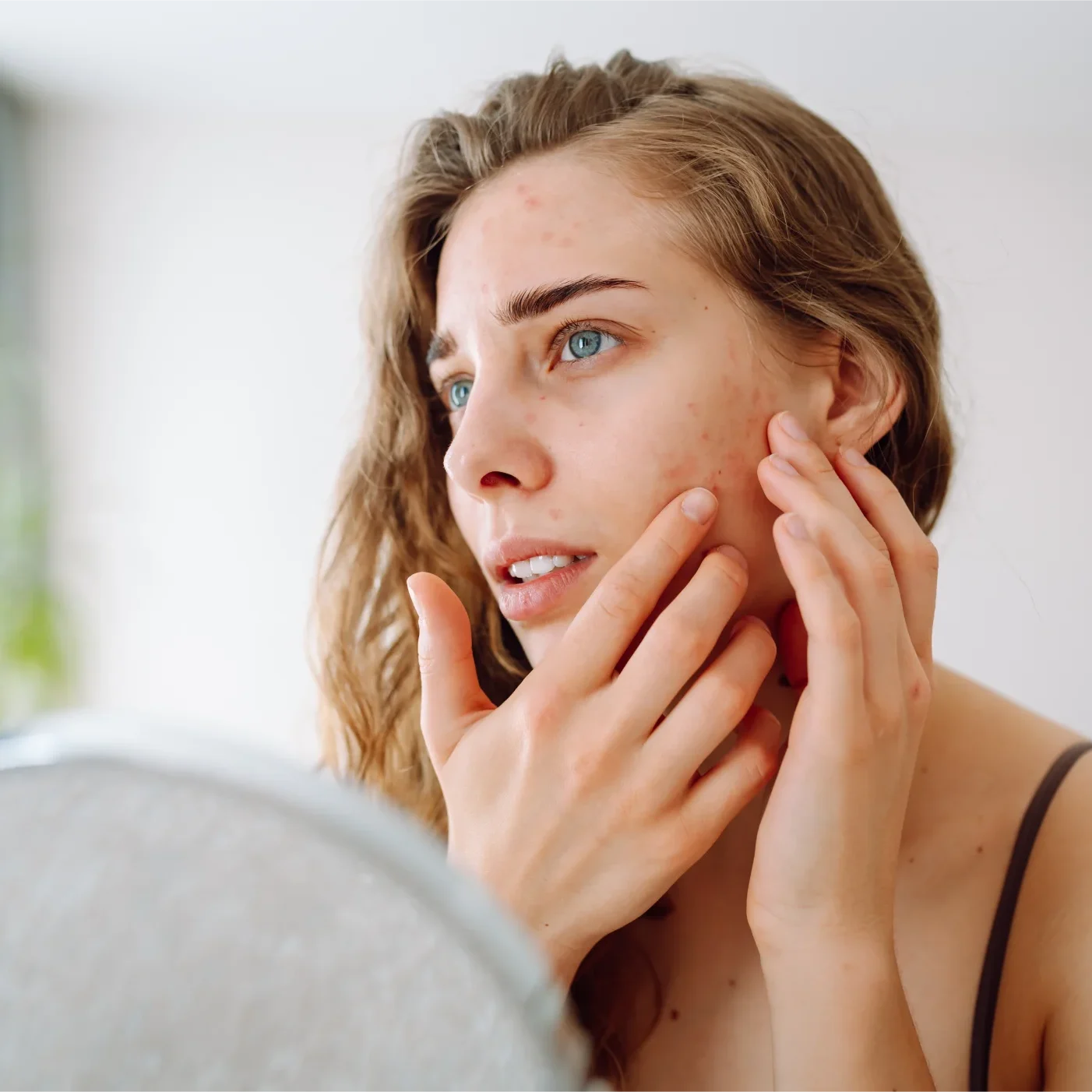 Best Moisturizer for Rosacea | Dermatologist Picks Canada