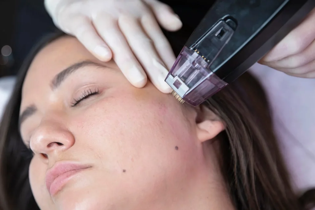 Skin Treatment - Morpheus 8 - Canada MedLaser