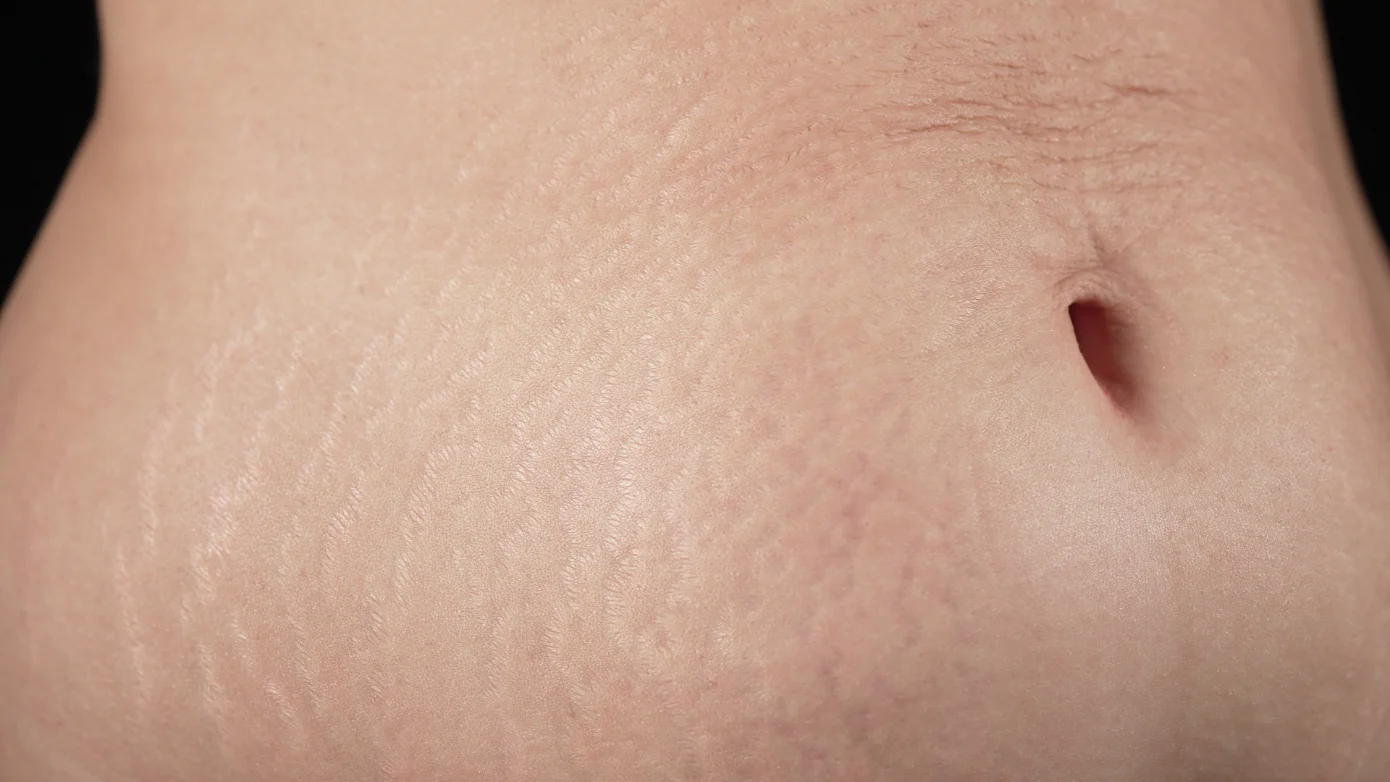 Stomach Stretch Marks