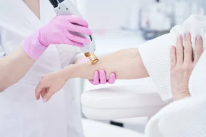 Person getting laser hair removal on arm