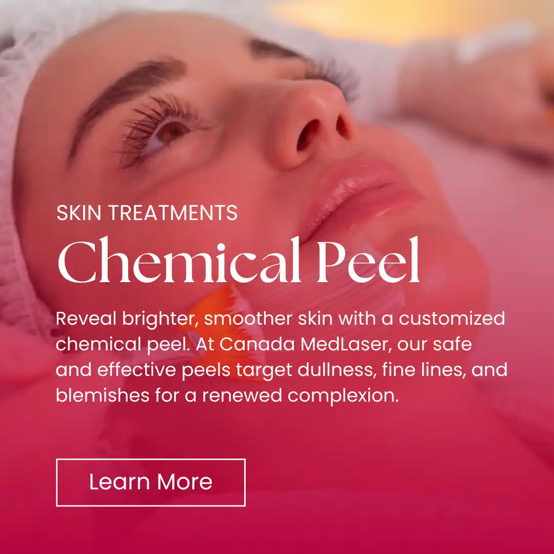 Skin - Chemical Peel