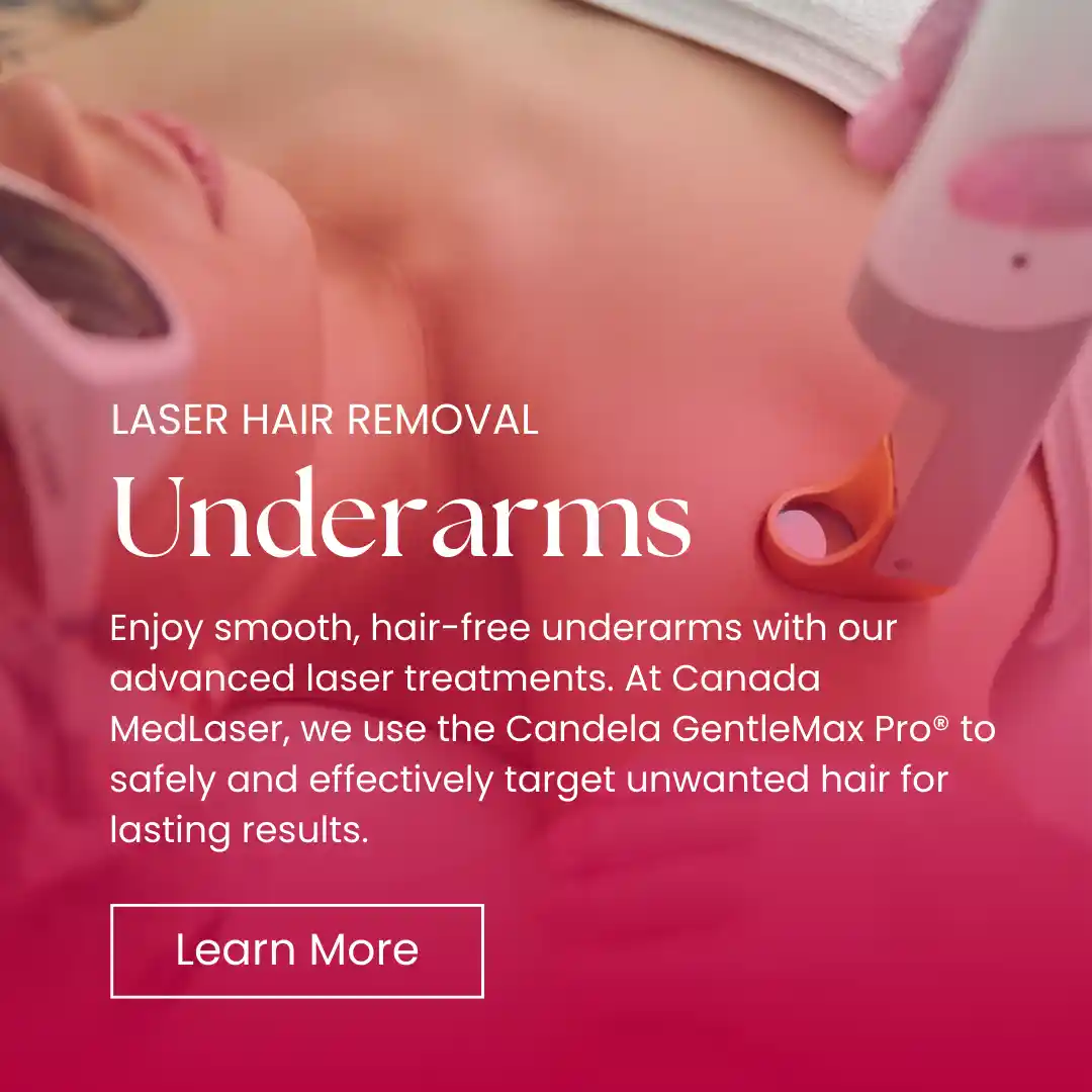 Hair Removal - Underarms