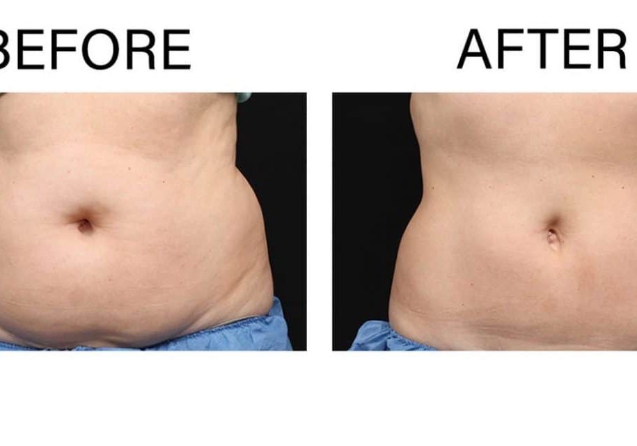 CoolSculpting