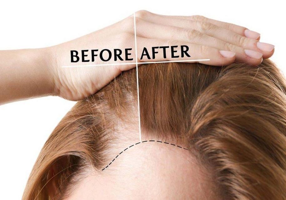 Hair Transplant Toronto